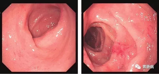 萎縮性胃炎不可怕，只要真正了解它