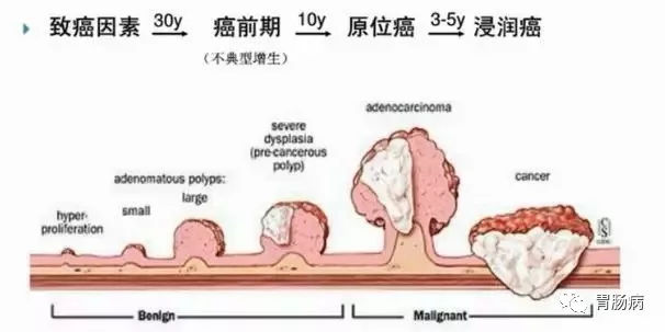 體檢查出腸息肉一定要切除！ 95%腸癌由它演變而來