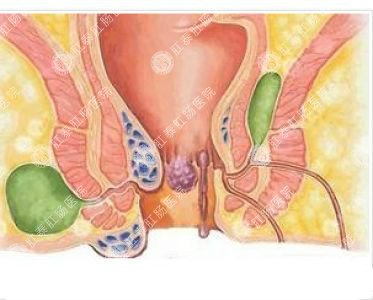 南寧哪個醫(yī)院可以做肛周膿腫？